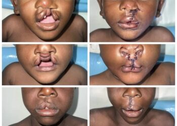 Tchad : La campagne de réparation des fentes labiales se poursuit à N&rsquo;djamena