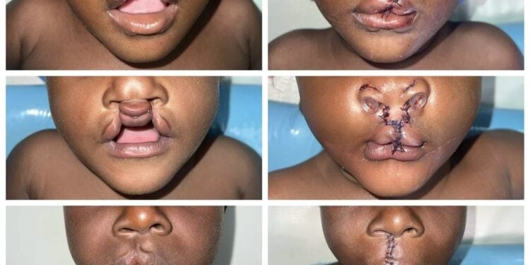 Tchad : La campagne de réparation des fentes labiales se poursuit à N&rsquo;djamena