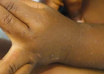 Tchad : La saison des pluies fait flamber les maladies de peau chez les enfants
