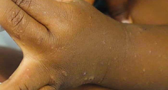 Tchad : La saison des pluies fait flamber les maladies de peau chez les enfants