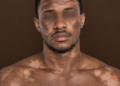 La dépigmentation masculine, entre diktat de séduction et risques sanitaires​