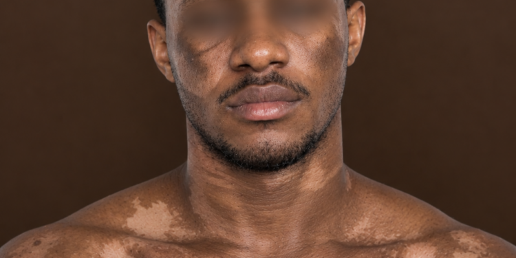 La dépigmentation masculine, entre diktat de séduction et risques sanitaires​
